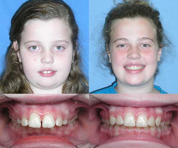 overbite before and after